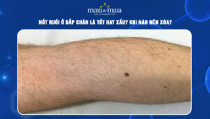 nốt ruồi ở bắp chân