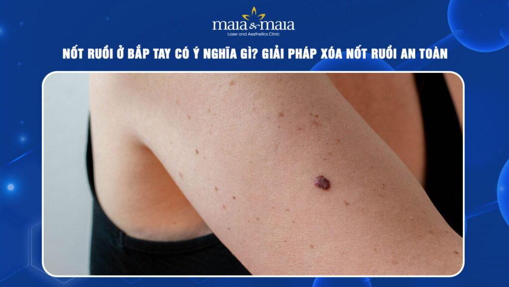 Nốt ruồi ở bắp tay