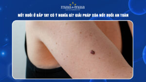 Nốt ruồi ở bắp tay