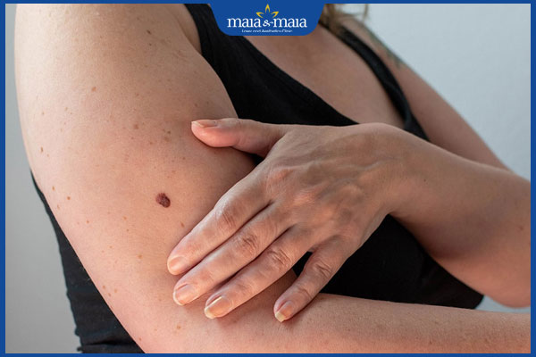 nốt ruồi ở bắp tay