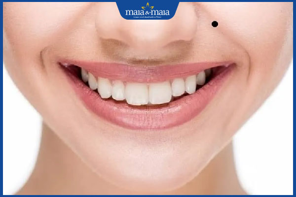 nốt ruồi ở bên trái đường pháp lệnh