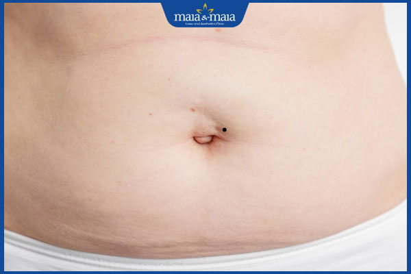 nốt ruồi ở bên trái rốn