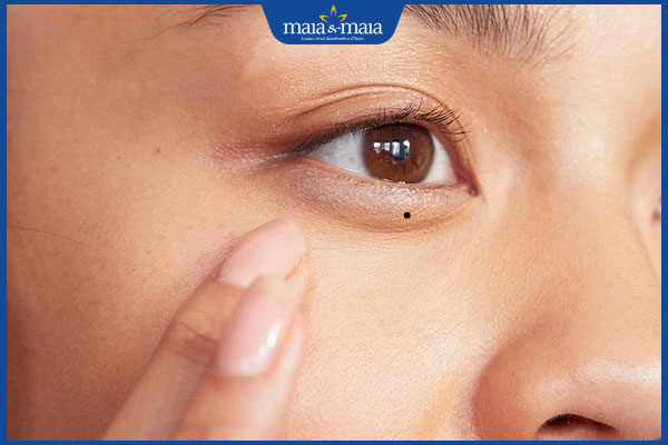 nốt ruồi ở bọng mắt