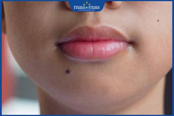 8 nốt ruồi xấu trên mặt phụ nữ và cách loại bỏ hiệu quả 5 nốt ruồi ở cằm nữ