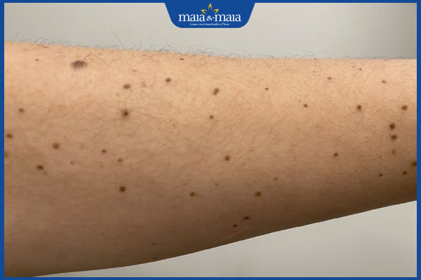 nốt ruồi ở cánh tay dưới