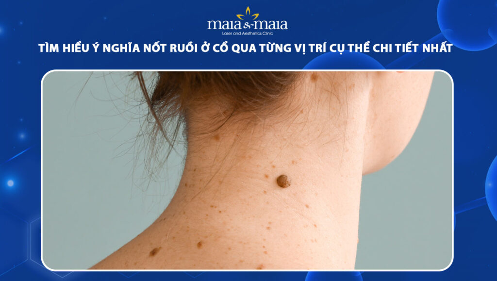 Tìm hiểu ý nghĩa nốt ruồi ở cổ qua từng vị trí cụ thể 1 nốt ruồi ở cổ