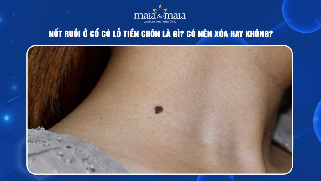 Nốt ruồi ở cổ có lỗ tiền chôn