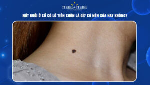 Nốt ruồi ở cổ có lỗ tiền chôn