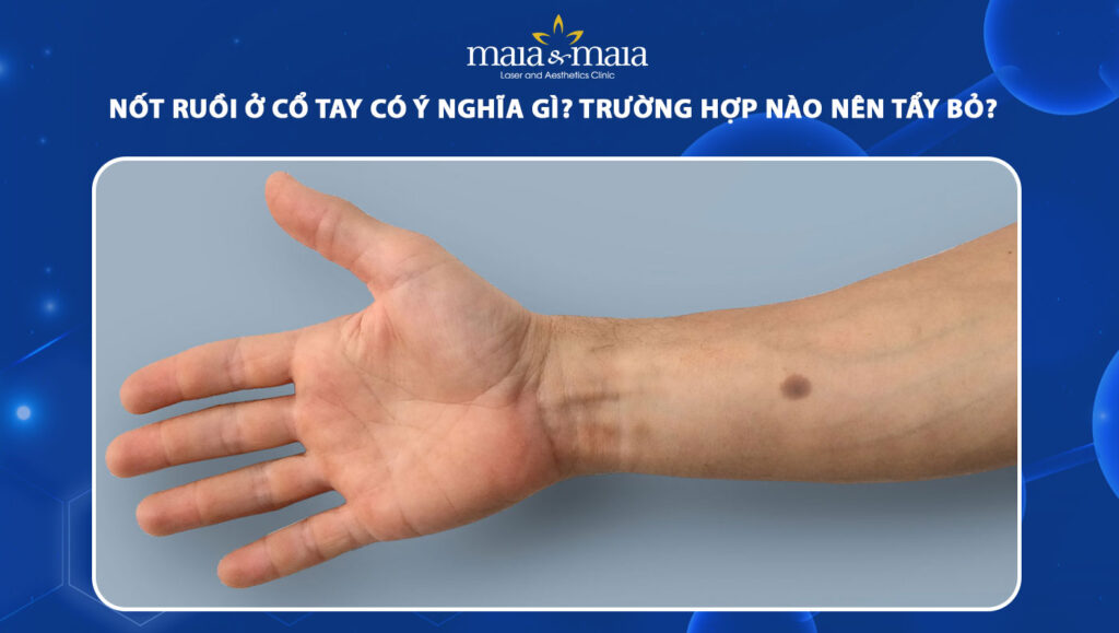 nốt ruồi ở cổ tay