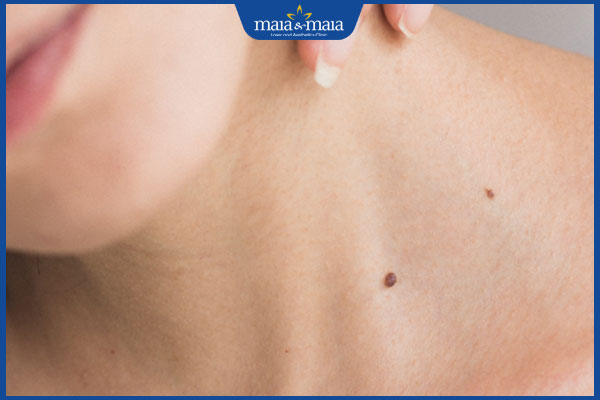 nốt ruồi ở cổ trái