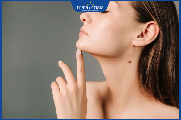 nốt ruồi ở cuối xương quai hàm