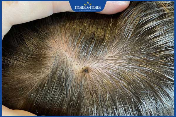 nốt ruồi ở đỉnh đầu lệch về bên phải