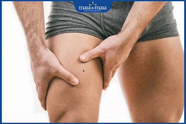Nốt ruồi ở đùi ẩn chứa ý nghĩa gì? Gợi ý địa chỉ tẩy bỏ nốt ruồi uy tín hiện nay 3 nốt ruồi ở đùi nam