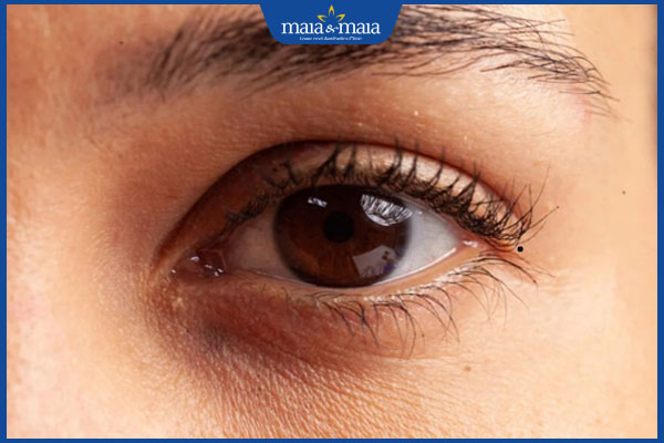 nốt ruồi ở đuôi mắt