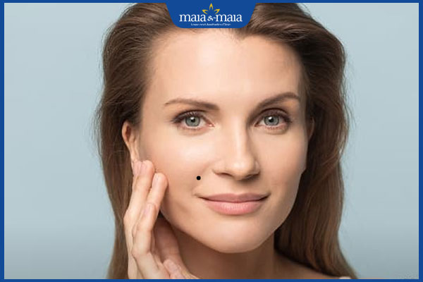 nốt ruồi ở đường pháp lệnh