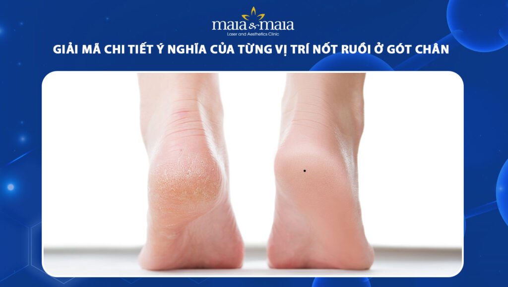 nốt ruồi ở gót chân