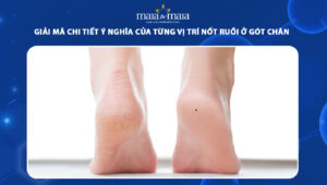 nốt ruồi ở gót chân