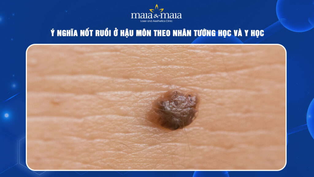 Nốt ruồi ở hậu môn