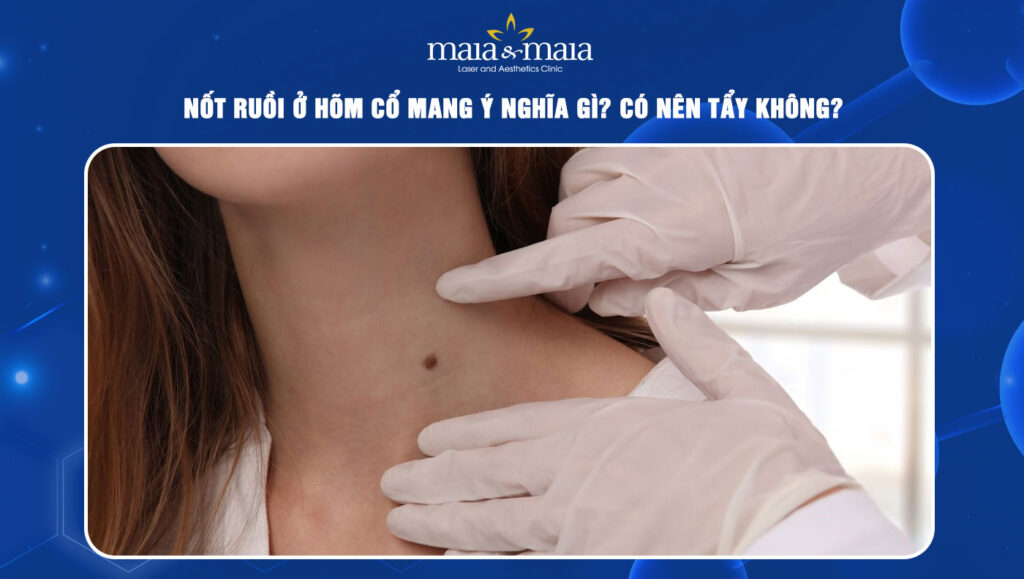 Nốt ruồi ở hõm cổ