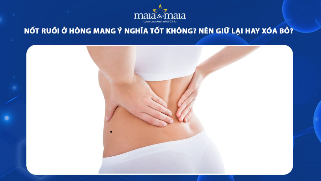 nốt ruồi ở hông
