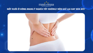 nốt ruồi ở hông