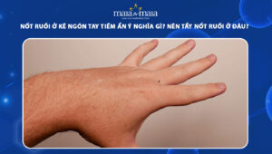 nốt ruồi ở kẽ ngón tay