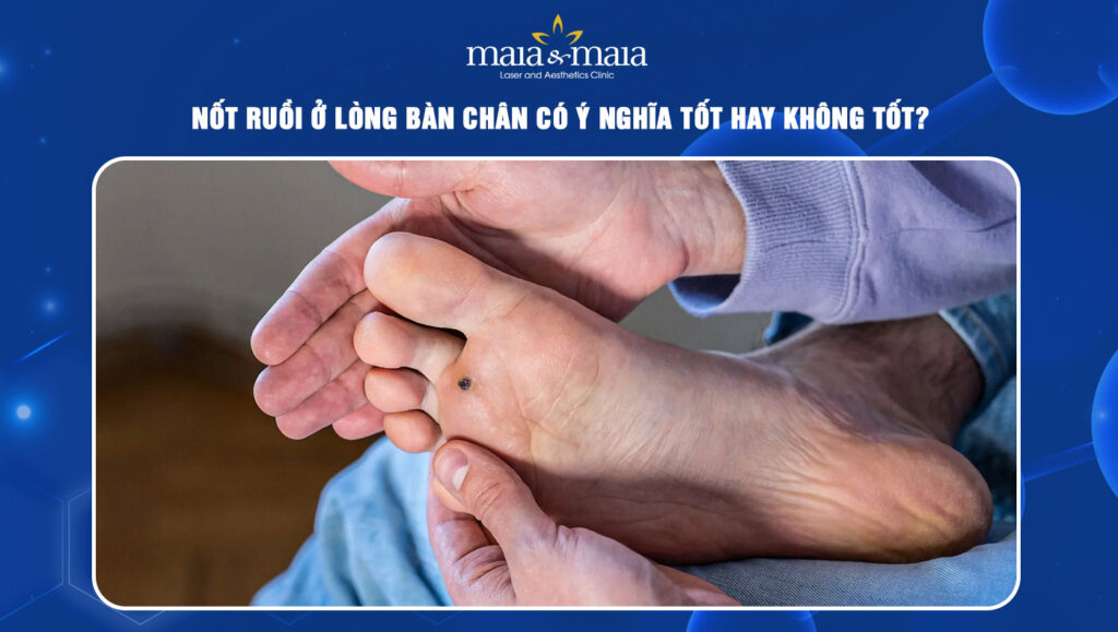 Nốt ruồi ở lòng bàn chân