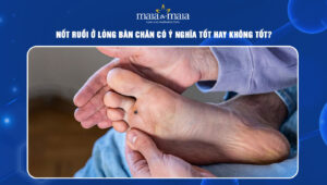Nốt ruồi ở lòng bàn chân