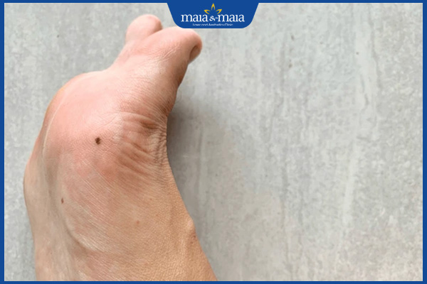 Nốt ruồi ở lòng bàn chân phải