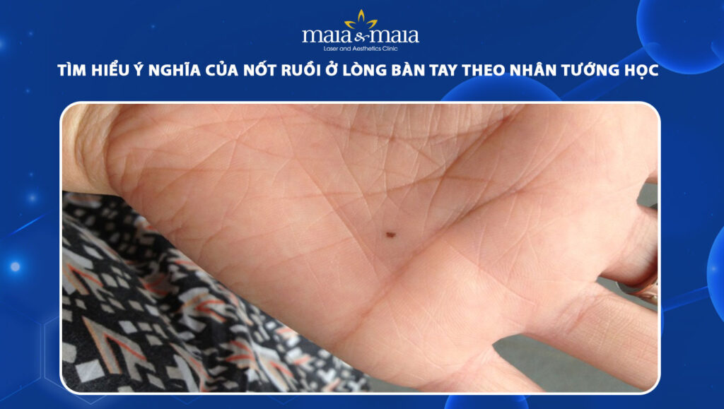 nốt ruồi ở lòng bàn tay