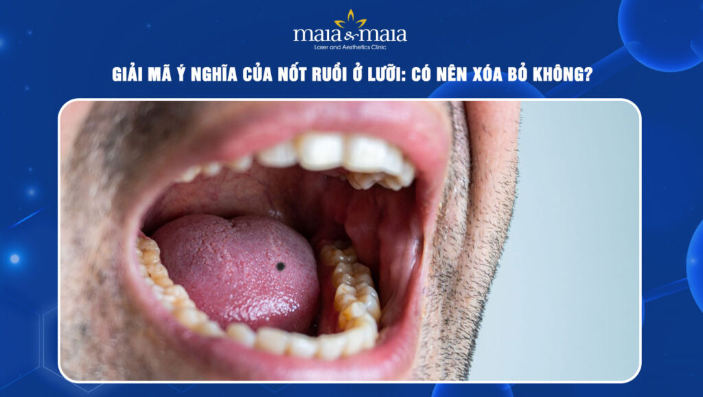 nốt ruồi ở lưỡi