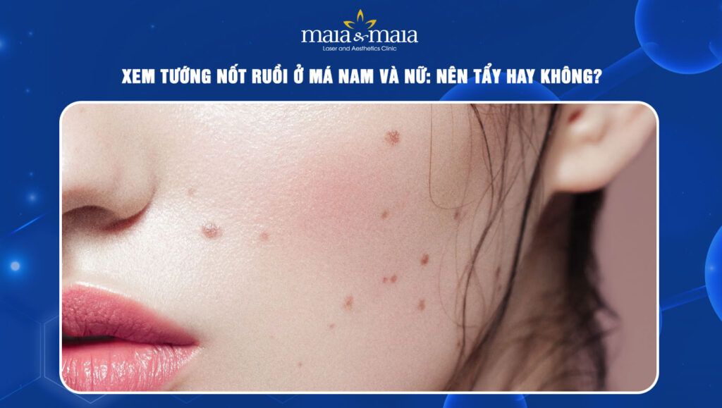 nốt ruồi ở má