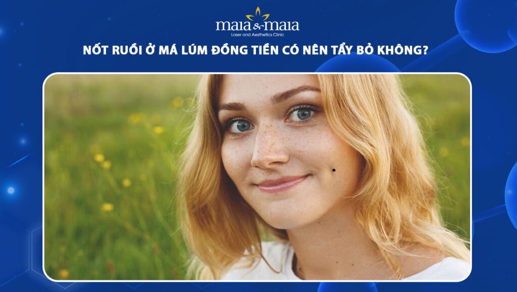 nốt ruồi ở má lúm đồng tiền
