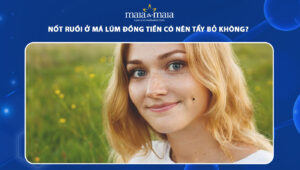 nốt ruồi ở má lúm đồng tiền
