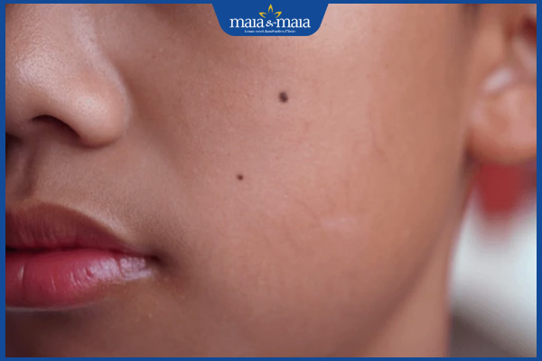 nốt ruồi ở má nữ