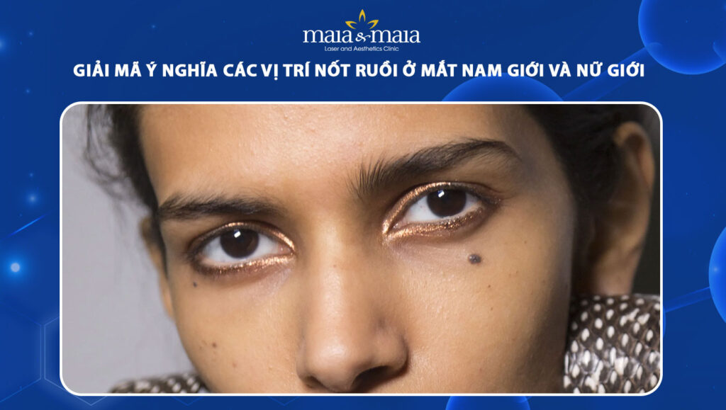 nốt ruồi ở mắt