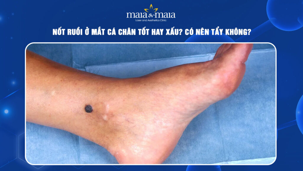 nốt ruồi ở mắt cá chân