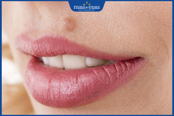 nốt ruồi ở mép nhân trung