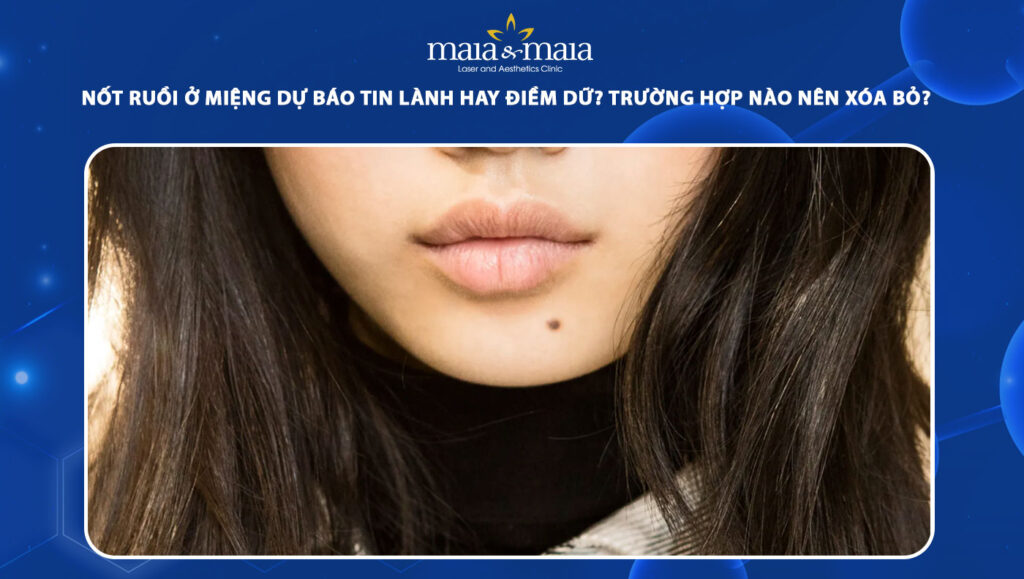 nốt ruồi ở miệng