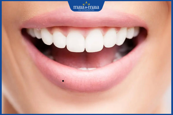 nốt ruồi ở môi dưới