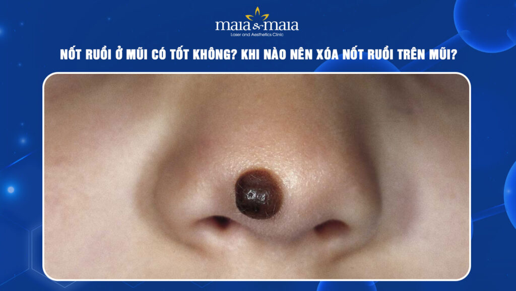 Nốt ruồi ở mũi