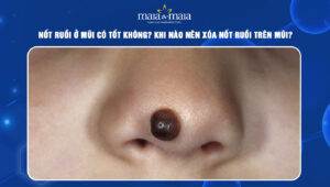 Nốt ruồi ở mũi