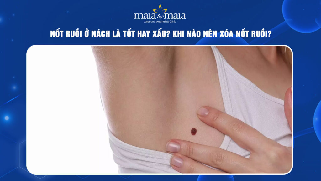 Nốt ruồi ở nách là tốt hay xấu? Khi nào nên loại bỏ? 1 nốt ruồi ở nách