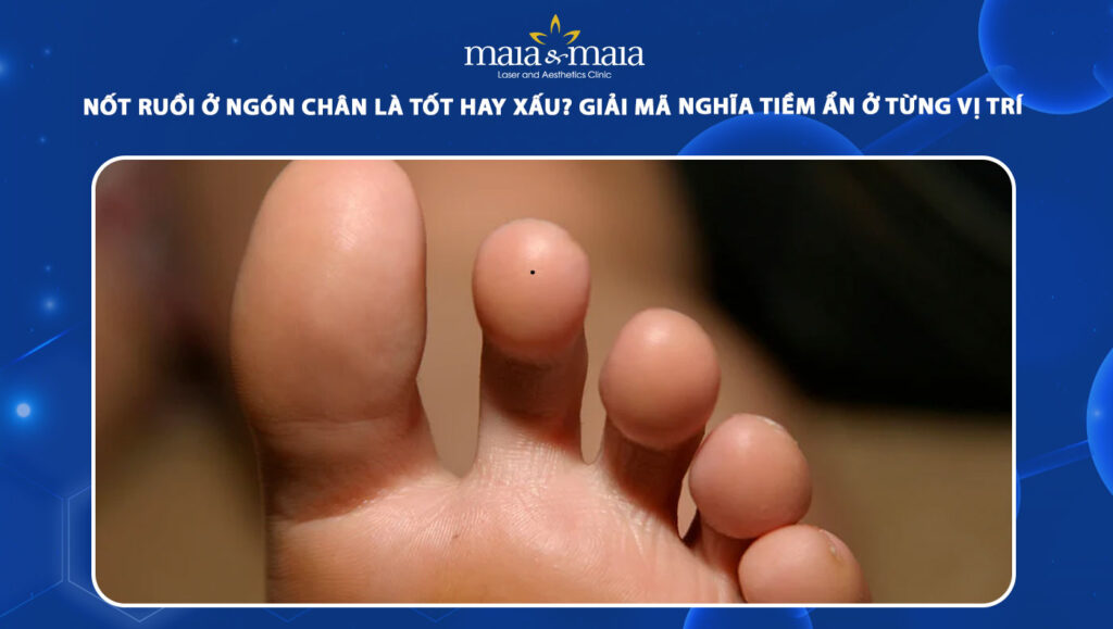 nốt ruồi ở ngón chân