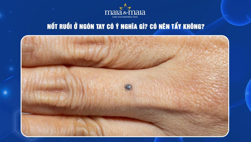 Nốt ruồi ở ngón tay có ý nghĩa gì? Có nên tẩy không? 1 nốt ruồi ở ngón tay