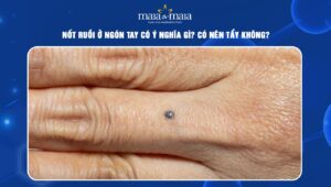 nốt ruồi ở ngón tay