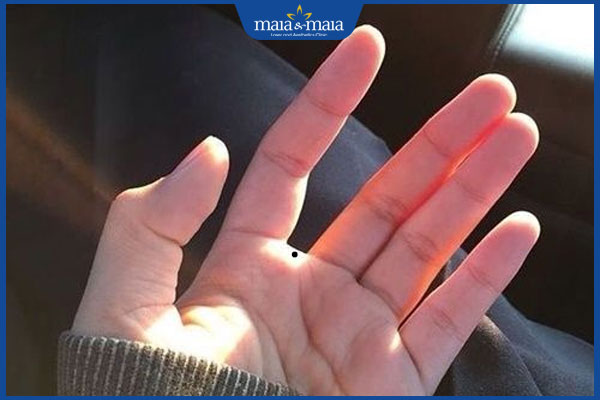 Nốt ruồi ở kẽ ngón tay tiềm ẩn ý nghĩa gì? Có nên tẩy không? 4 nốt ruồi ở ngón trỏ và ngón giữa