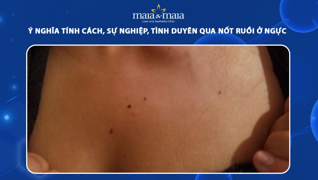 nốt ruồi ở ngực