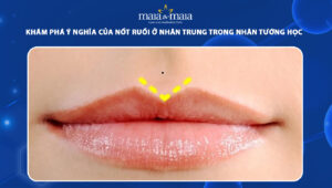 nốt ruồi ở nhân trung