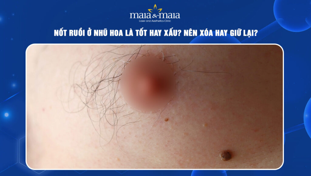 nốt ruồi ở nhũ hoa